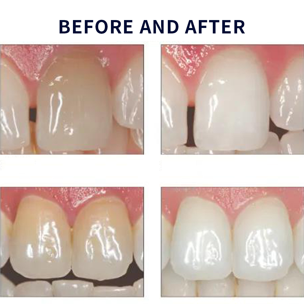 Opalescence Whitening 20% PF 2 - огляд і ціна Teeth Whitening Gel