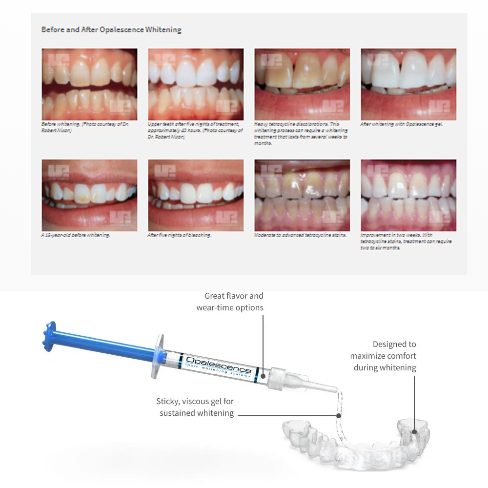 Opalescence Whitening 20% PF 2 - огляд і ціна Teeth Whitening Gel