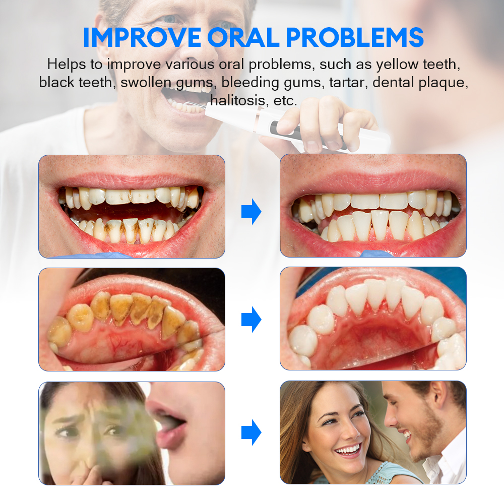 Electric Ultrasonic Dental Sca - огляд і ціна Teeth Whitening Home