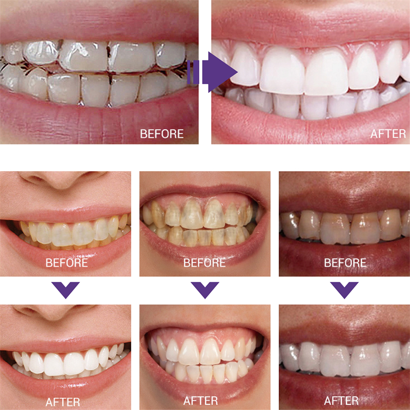 1pcs Teeth Cleansing Whitening - огляд і ціна Teeth Whitening Korea