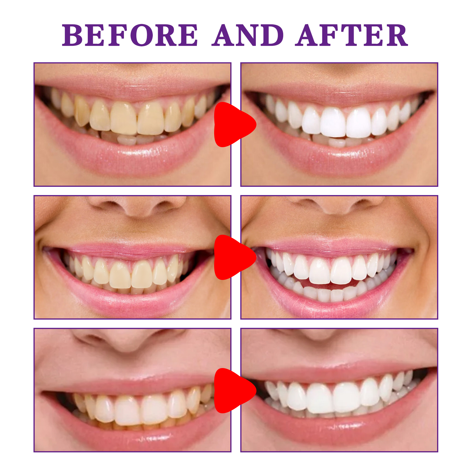 Teeth Cleansing Whitening Toot - огляд і ціна Teeth Whitening Korea