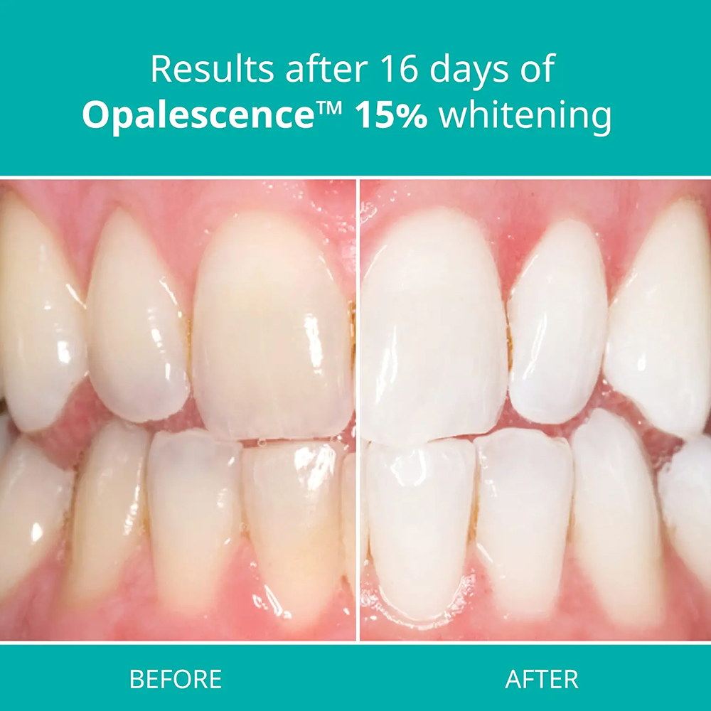 opalescence pf 15% refill kit  - огляд і ціна Teeth Whitening Gel Opalescence