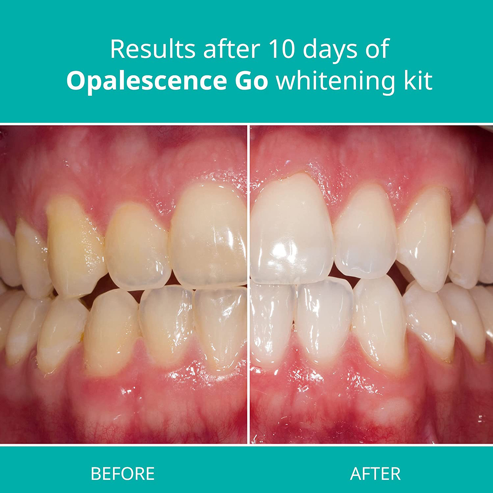 Opalescence Go Teeth Whitening - огляд і ціна Teeth Whitening Gel Opalescence