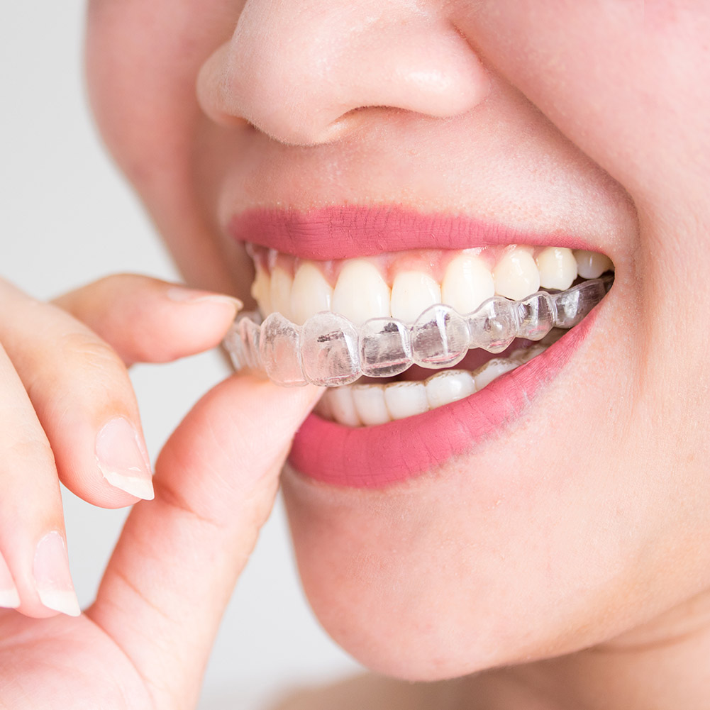 2/4pcs Mouth Guard Teeth Prote - огляд і ціна Teeth Whitening For Trays